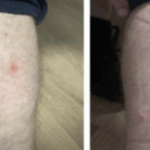 Polițiști mușcați de ploșnițe